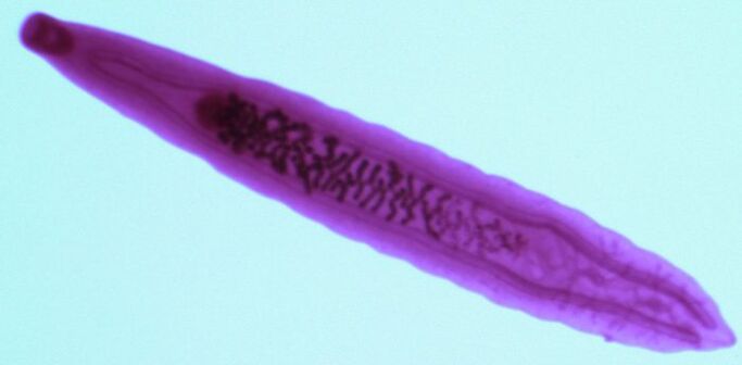 Leech parasites from the human body
